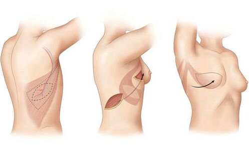 Druhy rezov pre mamoplasty