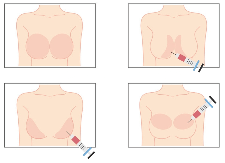 Miesta na injekciu kyseliny hyalurónovej do prsníka