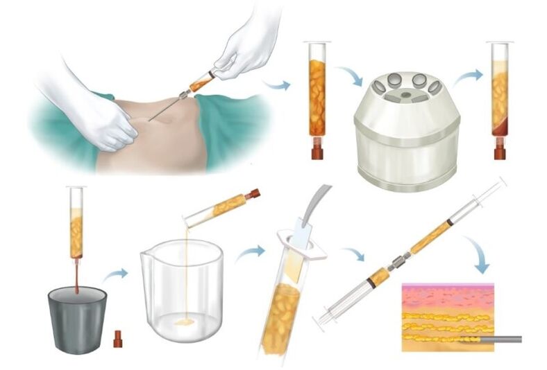 Odstránenie tuku z problémových oblastí, spracovanie a vstrekovanie do prsného tkaniva