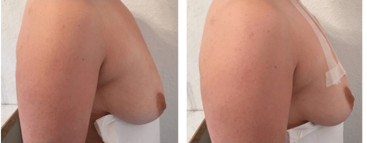 Pred a po zdvíhaní nití