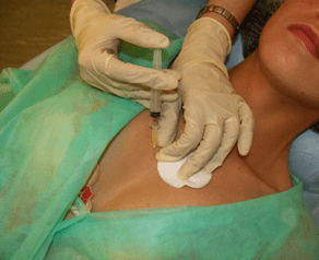 Zavedenie meso-koktailu do prsného tkaniva - alternatíva k injekciám kyseliny hyalurónovej