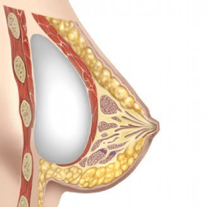 implantát na zväčšenie prsníkov